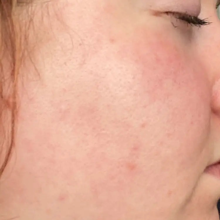 Close up of a person's face looking less red and more balanced after using SIX GLDN Essential Moisturizer.