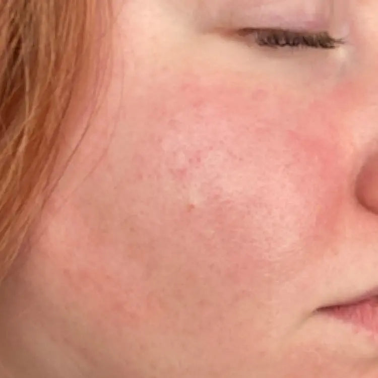 Close up of a person's face with visible texture and redness before using SIX GLDN Essential Moisturizer.
