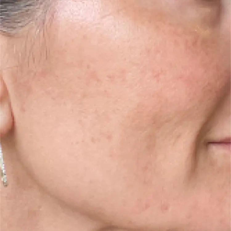 After 35 days using SIX GLDN Super G Youth Serum and Essential Moisturizer for sensitive, dry, breakout-prone and mature skin.