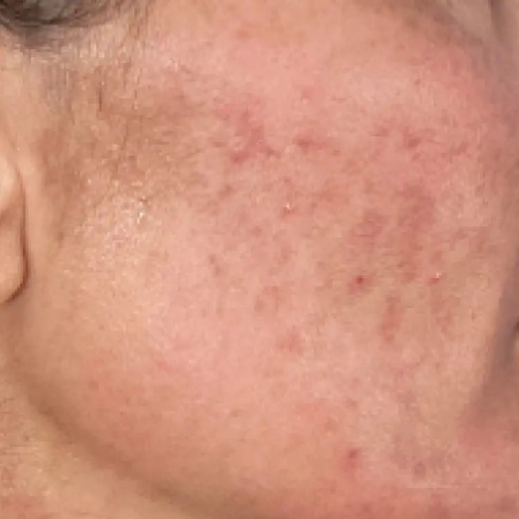 Before using SIX GLDN Super G Youth Serum and Essential Moisturizer for sensitive, dry, and breakout-prone skin.